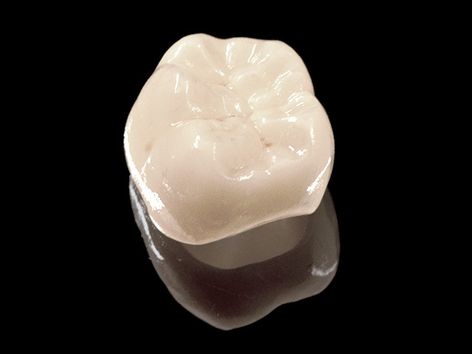  Lithium-Disilikat oder Zirkonoxid